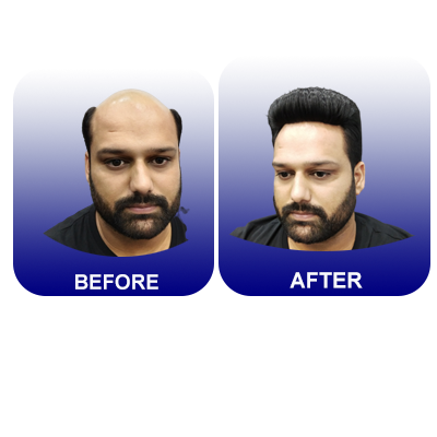veronica hair replacement solution - Delhi